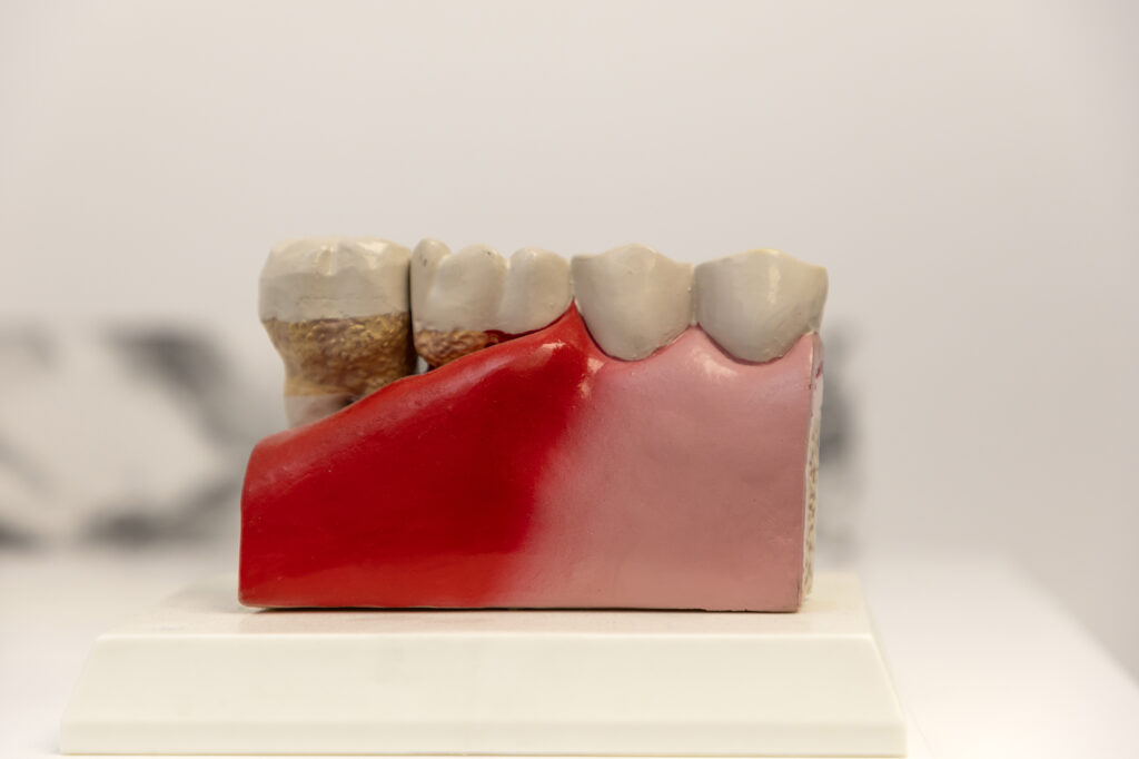 Infección bucodental - clínica SOPS de Badalona